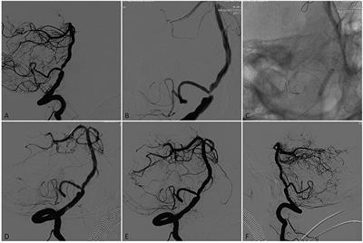 Neuroform EZ Stenting for Symptomatic Intracranial Artery Stenosis: 30 Days Outcomes in a High-Volume Stroke Center